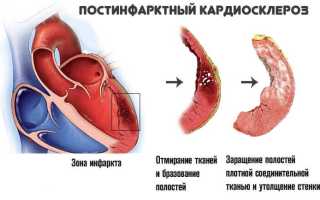 Постинфарктный кардиосклероз как причина смерти