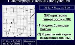 Признаки гипертрофии левого желудочка