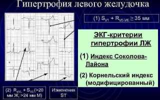 Признаки гипертрофии левого желудочка