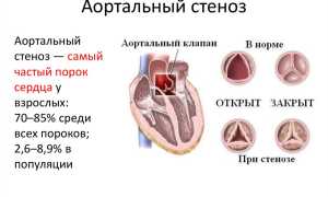 Аортальный стеноз