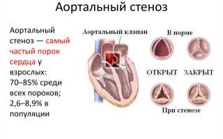 Аортальный стеноз