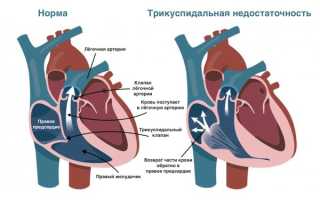Недостаточность трикуспидального клапана