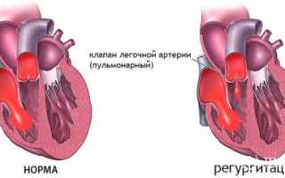 Недостаточность клапана легочной артерии