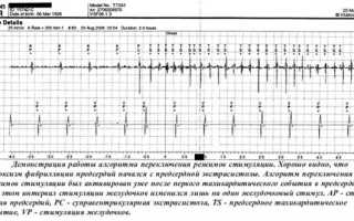 Код по МКБ-10 фибрилляции предсердий