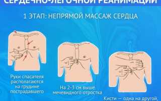 Сердечно-легочная реанимация