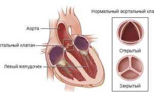 Аортальные пороки сердца