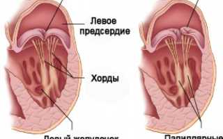 Диагноз: ПМК