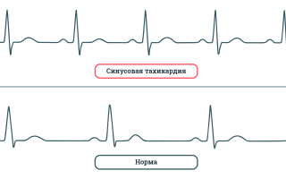 Берут ли в армию с тахикардией