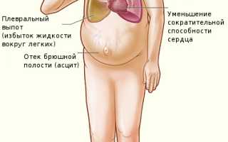 Сердечно-легочная недостаточность