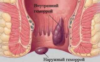 Геморрой у женщин: причины и средства