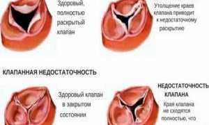 Приобретённыё пороки сердца