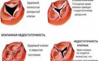 Приобретённыё пороки сердца
