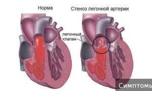 Что такое стеноз легочной артерии у новорожденных