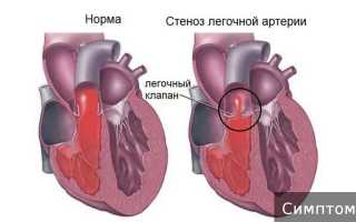 Что такое стеноз легочной артерии у новорожденных