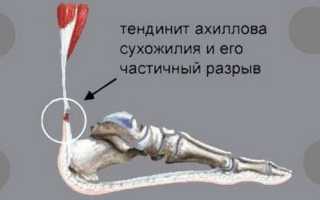 Тендинит локтевого сустава лечение