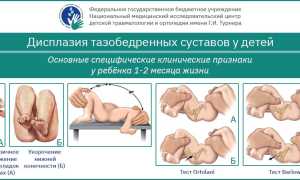 Незрелость тазобедренного сустава у новорожденных
