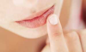 Хейлит на губах: методы лечения и мази
