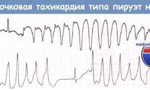Что такое аритмия типа пируэт