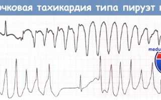 Что такое аритмия типа пируэт