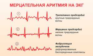 Постоянная форма фибрилляции предсердий