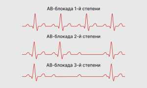АВ блокада 1 степени