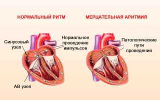 Аритмия сердца: симптомы и лечение