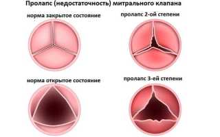 Степени пролапса митрального клапана
