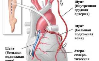 При каких заболеваниях сердца дают инвалидность