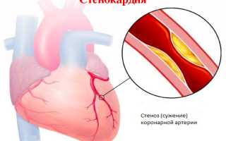 Спазм сосудов коронарных сосудов