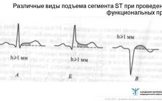 Ишемия на ЭКГ