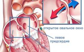 Открытое овальное окно у новорожденных