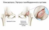 Коксартроз какой врач лечит