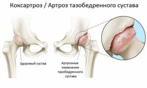Коксартроз какой врач лечит