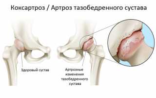 Коксартроз какой врач лечит