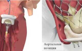 Протезирование митрального клапана сердца