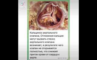 Кальциноз аортального клапана