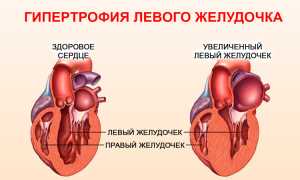 Гипертрофия левого желудочка сердца: что это и как можно лечить