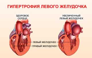 Гипертрофия левого желудочка сердца: что это и как можно лечить