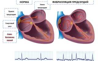 Персистирующая форма фибрилляции предсердий: что это такое