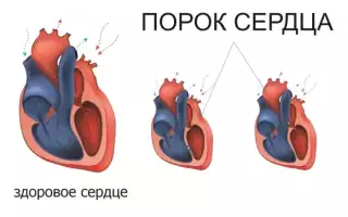 Что такое порок сердца и чем он страшен для жизни