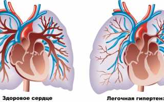 Легочное сердце