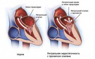 Митральный порок сердца