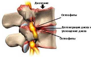 Краевые остеофиты