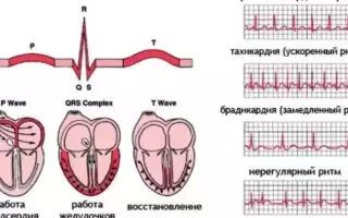 Синусовая брадикардия