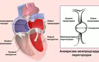 Аневризма межпредсердной перегородки