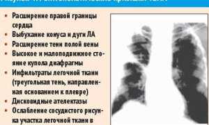 Симптомы ТЭЛА