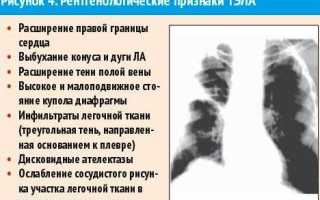 Симптомы ТЭЛА