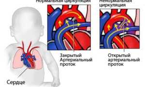 Порок сердца у детей