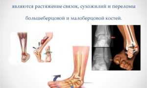 Почему болит голеностопный сустав