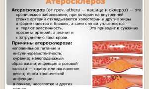 Атеросклероз аорты: этиология, клиника, диагностика, лечение